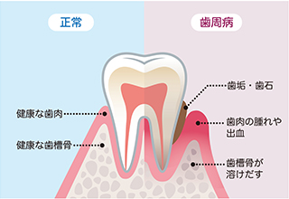 Caries 成人の約8割がかかっている～歯周病治療～