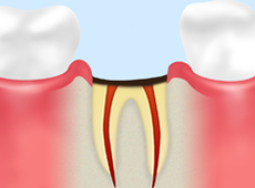 失った歯を放置するリスク