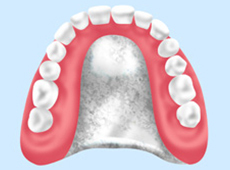 自費の入れ歯